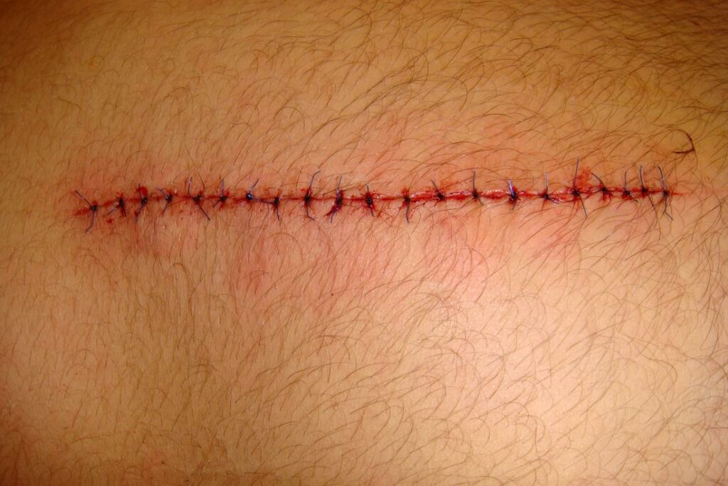 Τέλος στα ράμματα: Επαναστατική «βιοκόλλα» κλείνει πληγές στη στιγμή (Video) - Media