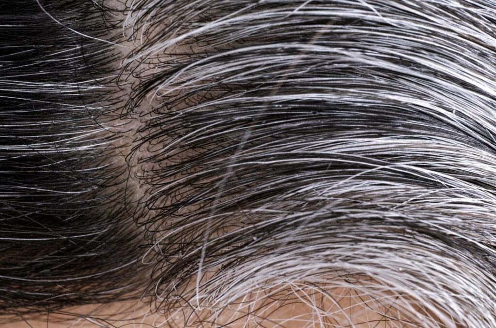 Πρόωρο γκριζάρισμα μαλλιών: Οι επτά πιθανές αιτίες - Media
