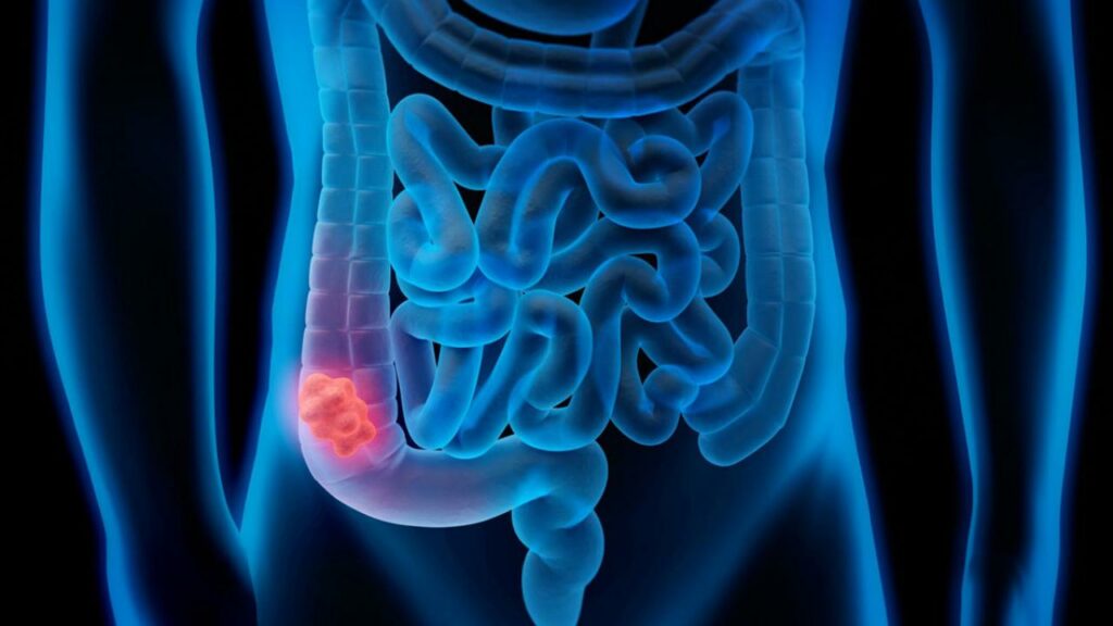 Καρκίνος του εντέρου: H τροφή που μειώνει τον κίνδυνο - Media