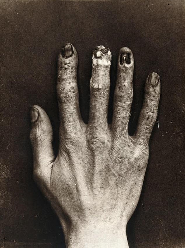 Το χέρι του βοηθού του εφευρέτη των ακτινών Χ που πέθανε από υπερβολική δόση ακτινοβολίας (Photos) - Media