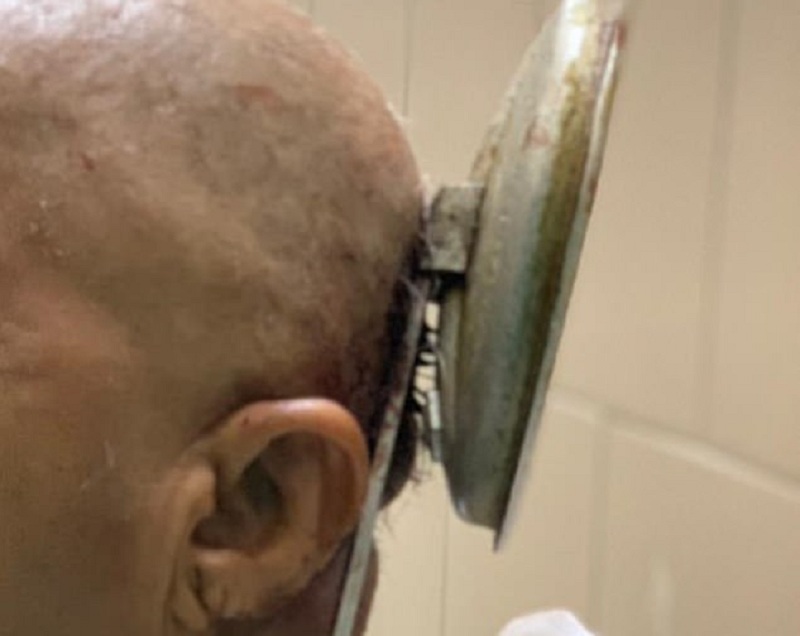 Γλίστρησε, έπεσε και καρφώθηκε το κεφάλι της στο καπάκι της χύτρας – Τρελάθηκαν οι γιατροί (Photos) - Media