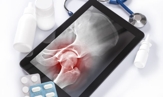 Οστεοσάρκωμα: Ο «ύπουλος» καρκίνος των οστών - Media