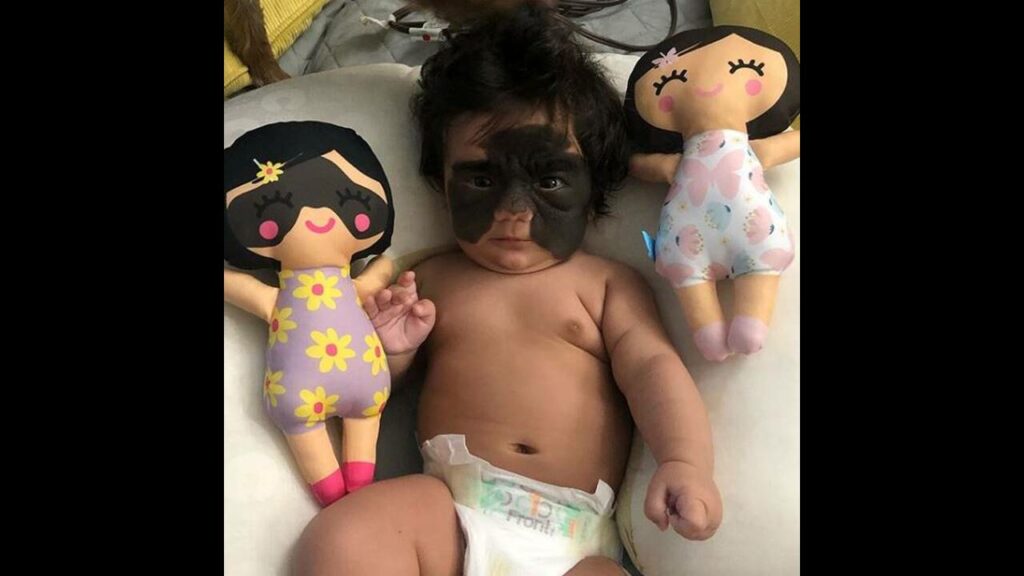 Μωρό «Mπάτμαν»: Είναι τεσσάρων μηνών και δέχεται ρατσιστικά σχόλια - «Πρέπει να θανατωθεί» - Media