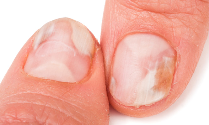 Μύκητες στα νύχια χεριών και ποδιών: Οι 8 κανόνες πρόληψης - Media