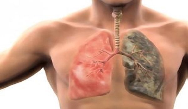 Καρκίνος πνεύμονα: Αυτό που αυξάνει τον κίνδυνο στους μη καπνιστές - Media