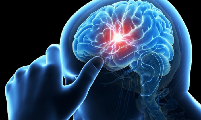 Εγκεφαλικό: Αυτά είναι τα πρώιμα συμπτώματα - Πώς να το προλάβετε - Media