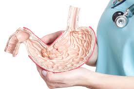 Καρκίνος στομάχου: Ποια τροφή τον καταπολεμά - Media