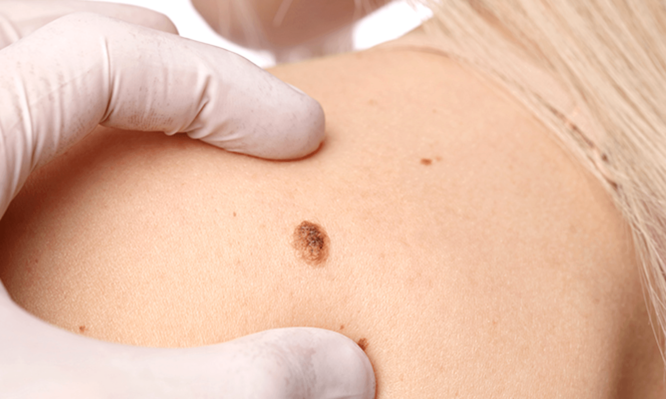 Μέλασμα: Η επιστημονική ανακάλυψη που καταπολεμά την ύπουλη αυτή μορφή καρκίνου - Media