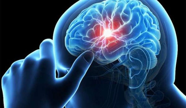 Ανεύρυσμα εγκεφάλου: Αυτά είναι τα πρώτα «αθώα» συμπτώματα - Media
