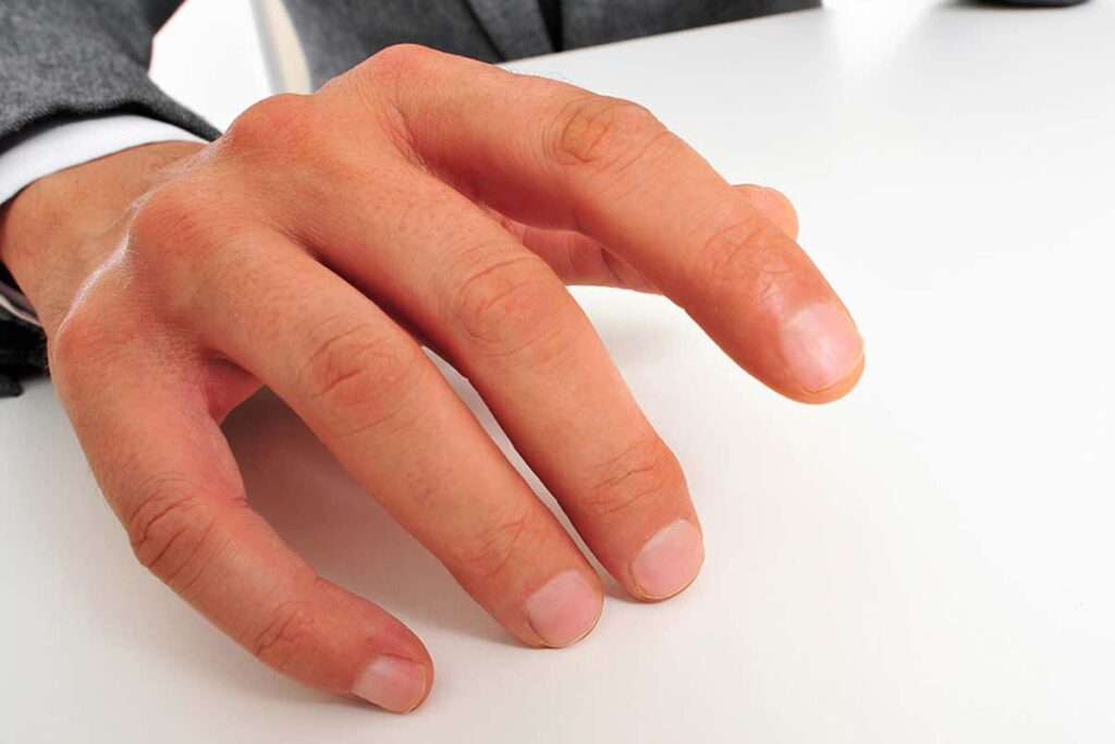 Μούδιασμα στα δάχτυλα: Ποιες σοβαρές παθήσεις μπορεί να κρύβει - Media