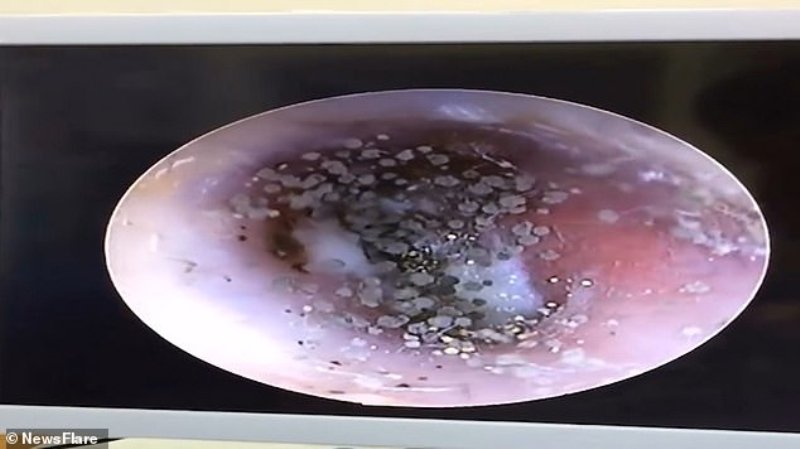 Δεκάδες «μανιτάρια» φύτρωσαν στο αυτί μιας γυναίκας (Video) - Media