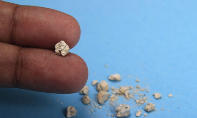 Τα «ύπουλα» σημάδια: Πώς θα καταλάβετε αν έχετε πέτρες στα νεφρά - Media