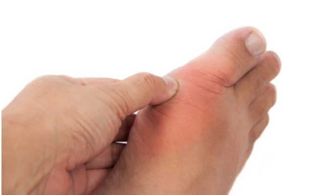 Μην υποτιμάτε το ουρικό οξύ: Ποιοι κινδυνεύουν - Πώς αντιμετωπίζεται  - Media