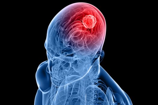 Εγκεφαλίτιδα: Η «ύπουλη» φλεγμονή του εγκεφάλου  - Ποια τα πρώτα συμπτώματα  - Media