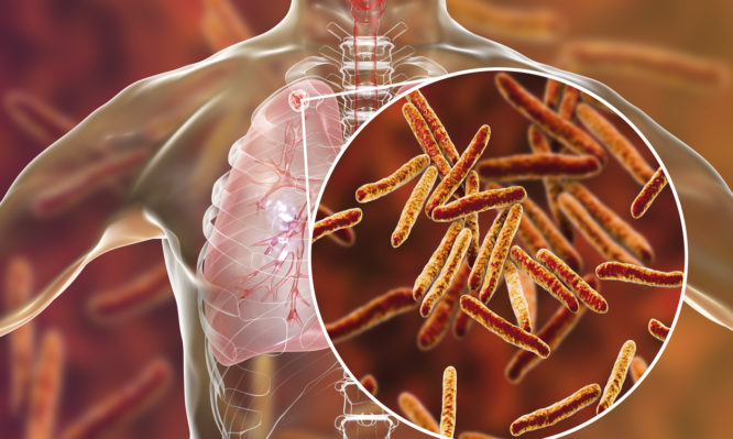 Φυματίωση: Πώς κολλάει - Ποια τα πρώτα συμπτώματα - Media