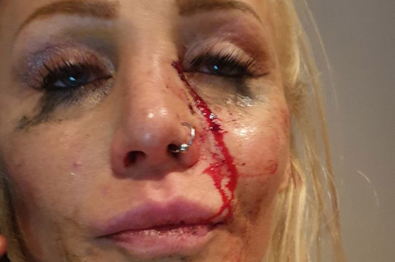 Την πλάκωσε στο ξύλο η μπαργούμαν (Σκληρές Photos) - Media