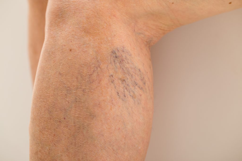 Κιρσοί: Ποιες σοβαρές ασθένειες μπορεί να κρύβουν - Media