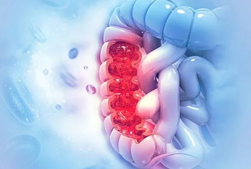 Καρκίνος του πρωκτού: Τα ασαφή πρώιμα συμπτώματα - Media