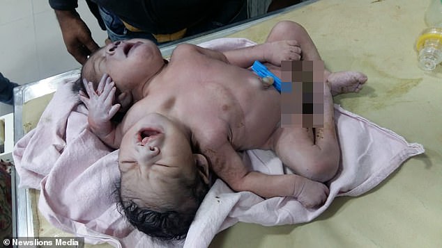 Μωρό γεννήθηκε με 2 κεφάλια και 3 χέρια (Σκληρές Photos/Video) - Media