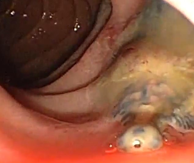 Άνδρας έτρωγε άπλυτα λαχανικά και ένα σκουλήκι του μόλυνε το πάγκρεας (Video) - Media