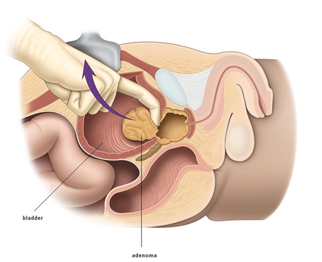 Υπερπλασία του προστάτη: Ποια τα πρώτα συμπτώματα  - Media