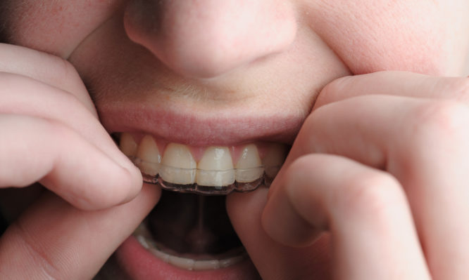 Τι να προσέξουν στις γιορτές όσοι φορούν «αόρατα σιδεράκια» - Media