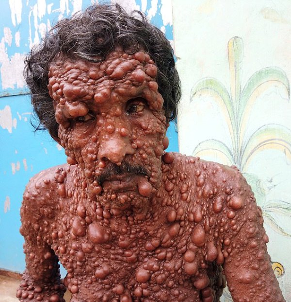 Ο άνθρωπος με τις φυσαλίδες: Εκατοντάδες μικροί όγκοι καλύπτουν το σώμα του (Photos) - Media