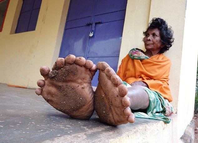 Η γυναίκα με τα περισσότερα δάχτυλα σε χέρια και πόδια - Οι χωριανοί τη φωνάζουν «μάγισσα» (Photos/Video) - Media