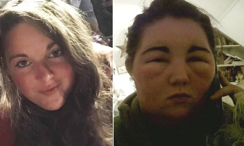 Έπαθε αλλεργία από τη βαφή μαλλιών και λίγο έλειψε να πεθάνει - Της άφησε μόνιμες βλάβες (Photos) - Media