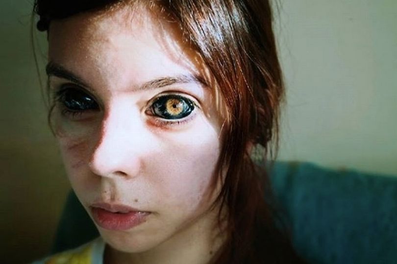 Έκανε τατουάζ στους βολβούς των ματιών της και τυφλώθηκε (Photos) - Media