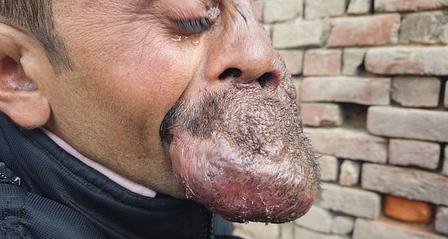 Ο Ινδός ιερέας με τον τεράστιο όγκο στο κεφάλι που λατρεύεται ως θεός (Photos) - Media