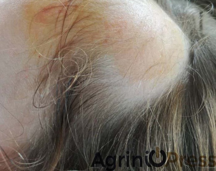 Αγρίνιο: Σοκαριστικό ατύχημα σε νηπιαγωγείο! Ξεριζώθηκαν τα μαλλιά 5χρονης (Photos) - Media