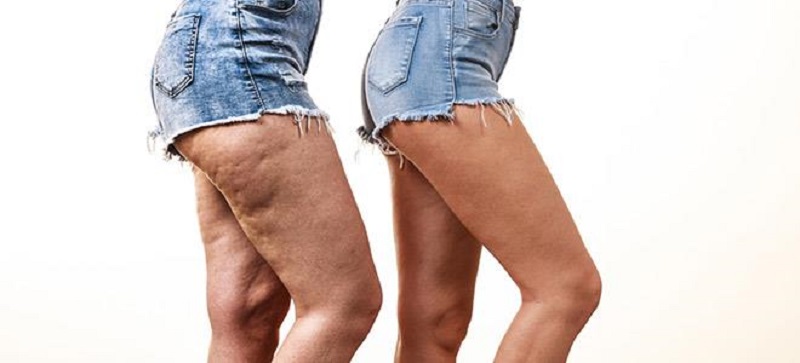 Κυτταρίτιδα: Τι είναι ο φλοιός πορτοκαλιού και πώς αντιμετωπίζεται - Media