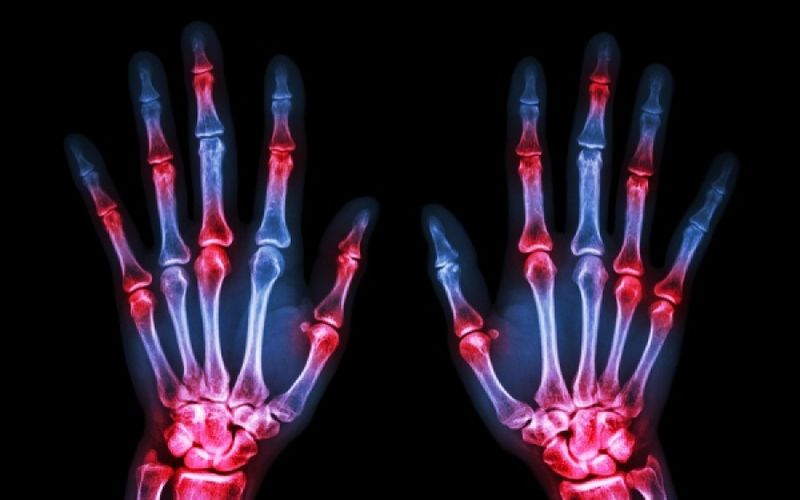 Το «κρακ» στα δάχτυλα προκαλεί ή όχι αρθρίτιδα στα χέρια; (Video) - Media