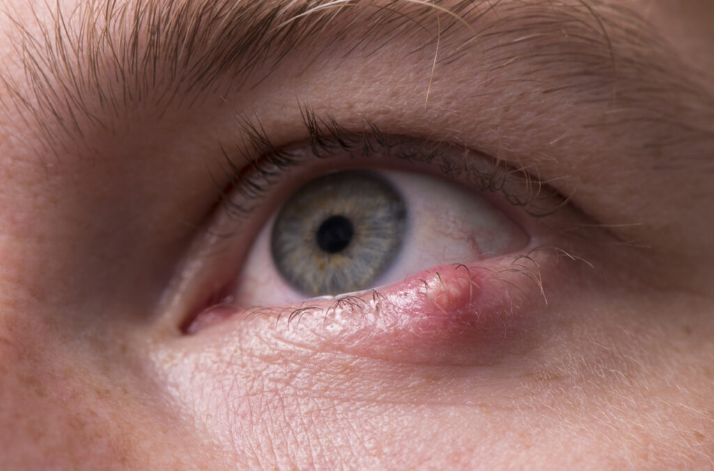 Κριθαράκι στο μάτι: Δείτε τις 4 φυσικές θεραπείες - Media