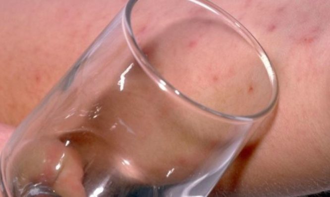 Μηνιγγίτιδα – Σημάδι στο δέρμα: Πώς γίνεται το «τεστ με το ποτήρι» - Media