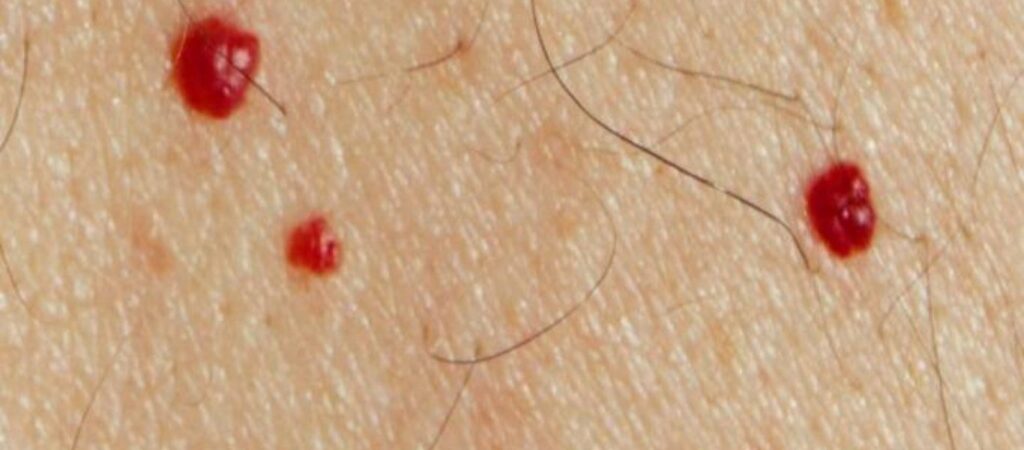 Κόκκινες ελιές στο δέρμα: Πότε βγαίνουν, ποιοι τύποι υπάρχουν και τι να προσέχετε - Media