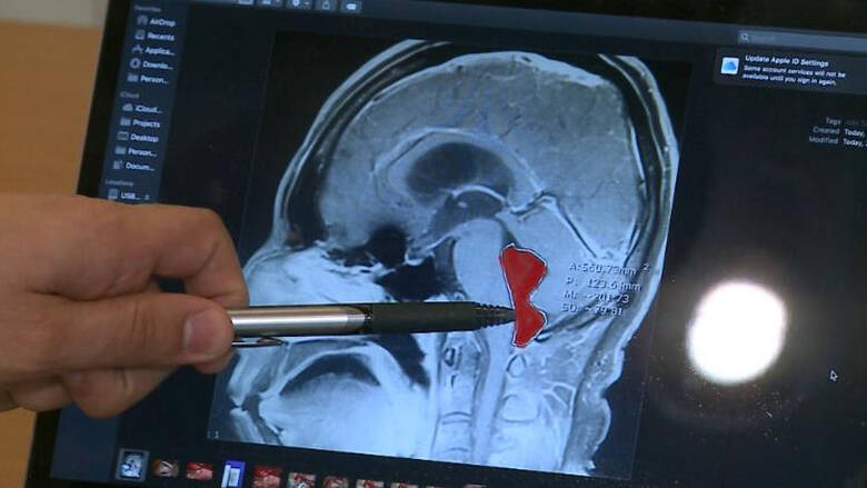 Ανατριχιαστική διάγνωση: Χρόνιοι πονοκέφαλοι από κακομαγειρεμένο χοιρινό! - Media
