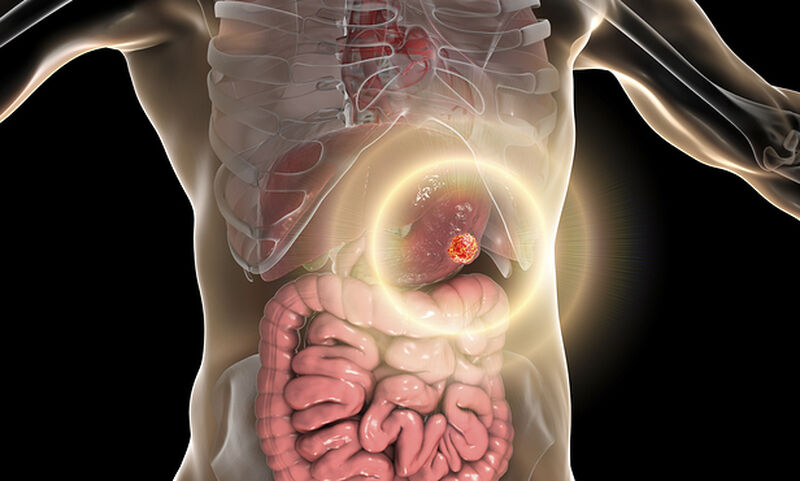 Καρκίνος Στομάχου: Η πολύτιμη τροφή που τον… προλαβαίνει - Media