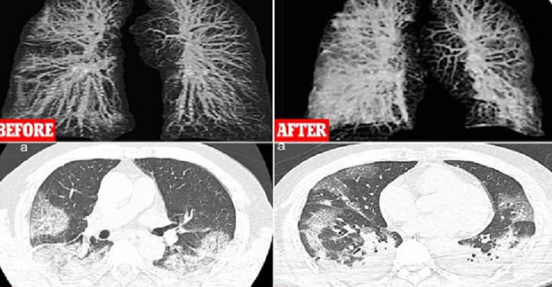 Σοκαριστικές ακτινογραφίες: Οι πνεύμονες πριν και μετά τον κορωνοϊό  - Media
