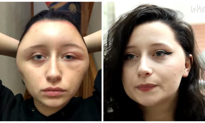Έπαθε αλλεργία από βαφή μαλλιών - Το κεφάλι της διογκώθηκε στο διπλάσιο! (Videos|Photos) - Media