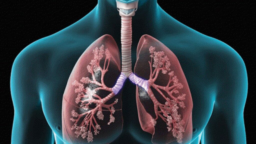 Ασθενείς με «ΧΑΠ» κινδυνεύουν από καρκίνο πνευμόνων και ας μην έχουν καπνίσει ποτέ! - Media