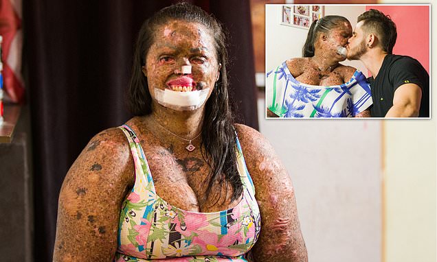 Το μαρτύριο μιας γυναίκας με σπάνια δερματολογική πάθηση που την κάνει να μοιάζει με ζόμπι (Photos) - Media
