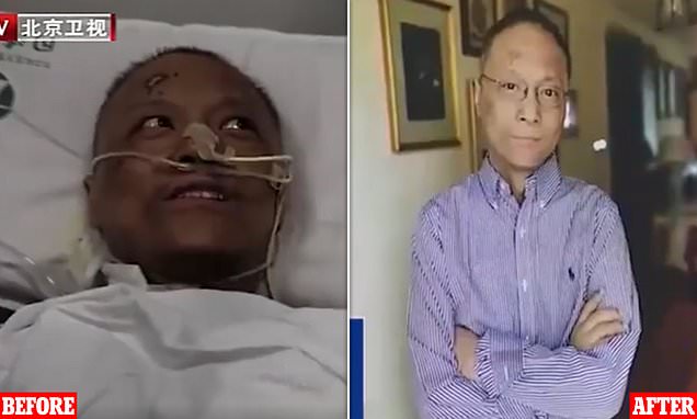Κινέζος γιατρός στην Ουχάν κόλλησε κορωνοϊό  - Του έκαναν θεραπεία και σώθηκε αλλά το χρώμα του έγινε μαύρο (Photos) - Media