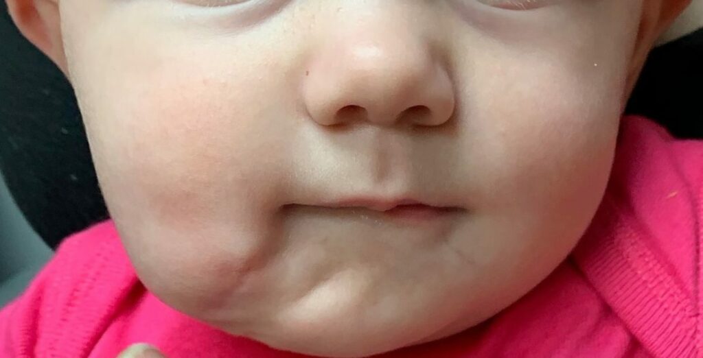 Γεννήθηκε μωρό με δύο στόματα: Δείτε εικόνες πριν και μετά την επέμβαση των γιατρών  - Media