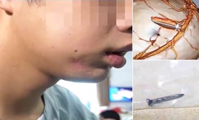 Οικοδόμος έπαιζε με το πιστόλι που καρφώνουν τα καρφιά στο μπετόν – Πάτησε κατά λάθος τη σκανδάλη και ένα μεγάλο καρφί σφηνώθηκε στο κρανίο του (Photos) - Media