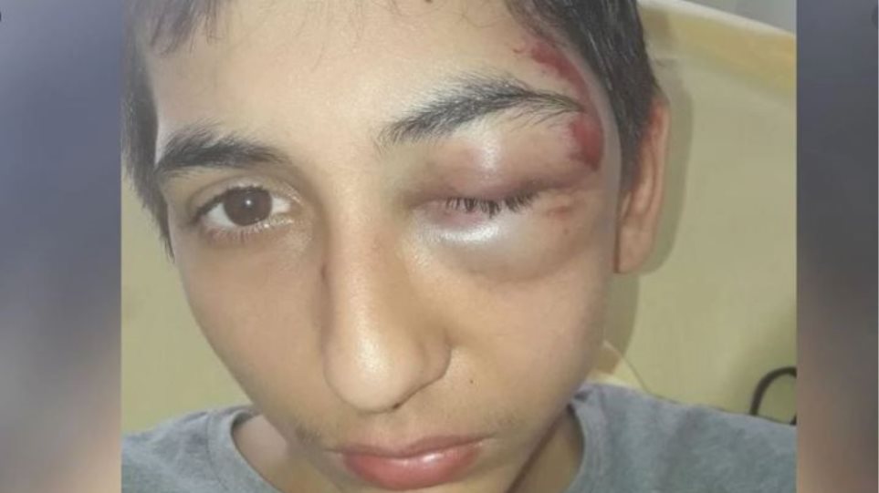 Γαλλία: Υπόθεση... ζαρντινιέρας με 14χρονο Ρομά - «Ένας μουσάτος αστυνομικός με κλώτσησε στο πρόσωπο» (Video)  - Media