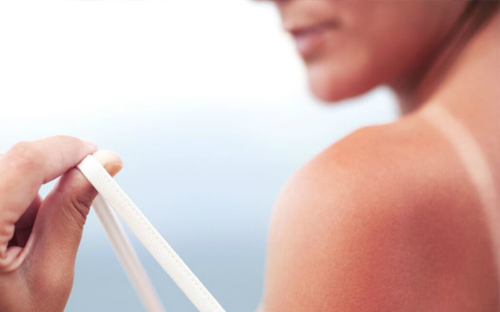 Κάηκες από τον ήλιο; Τα σωστά βήματα για θεραπεία! - Media