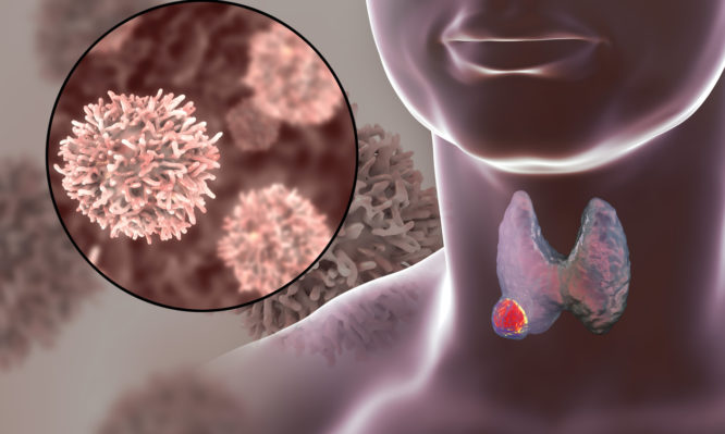 Καρκίνος του θυρεοειδούς: Σημάδια και συμπτώματα που πρέπει να ξέρετε - Media