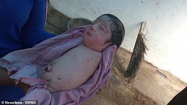 Ινδία: Κοριτσάκι γεννήθηκε χωρίς χέρια και πόδια λόγω σπάνιας γενετικής διαταραχής (Photos/Video) - Media
